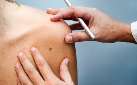 Вчені назвали поширений вірус, який може викликати рак шкіри