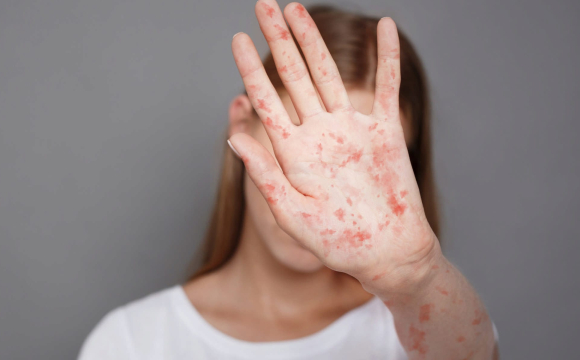 В Україні зафіксували спалах небезпечної інфекції