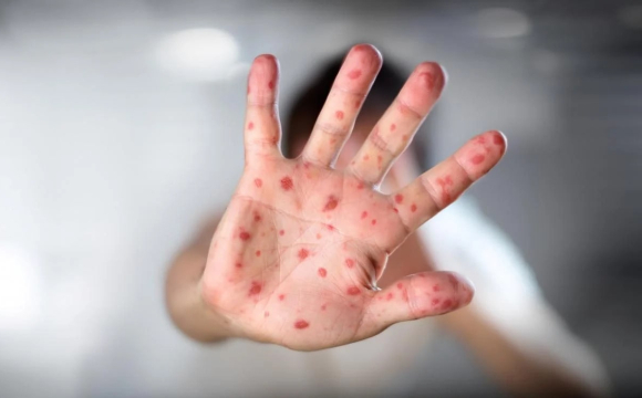 В Україні зафіксували спалах вітрянки: яка ситуація на Волині