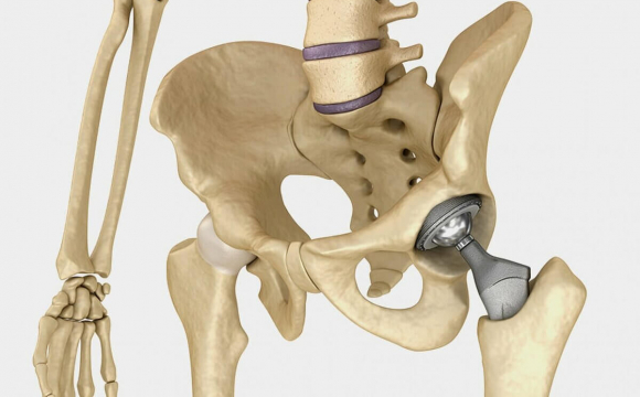 Эндопротезирование тазобедренного сустава: где лучше делать?*