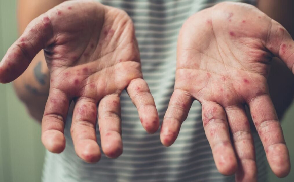 Україною шириться небезпечний вірус: хто у зоні ризику