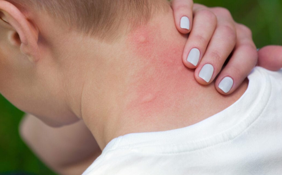 На Волині зростає кількість хворих через укуси небезпечних комах