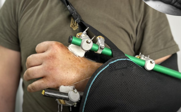 Під час заготівлі дров чоловік відрізав собі руку бензопилою